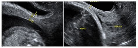 measuring cesarean scar thickness|uterus scar size after cesarean section.